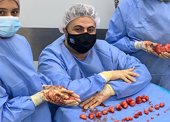 فريق طبي في مستشفى الملك عبدالعزيز بالأحساء يخلص مريضة من 34 ليف في رحمها