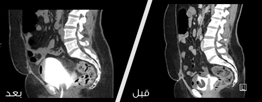 صورة اشعة قبل وبعد عملية إصلاح ناسور