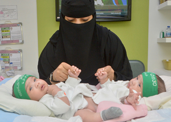 عملية فصل التوأم السيامي السعودي (شيخة وشموخ) غدا الخميس 16 صفر 1440هـ