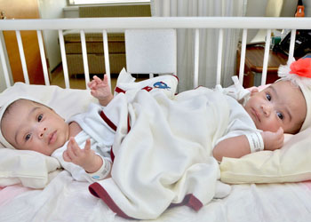 عملية فصل التوأم السيامي السعودي (شيخة وشموخ) غدا الخميس 16 صفر 1440هـ