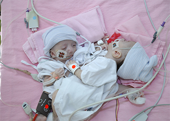 Palestinian Conjoined Twins Hanin and Farah Arrive in Saudi Arabia