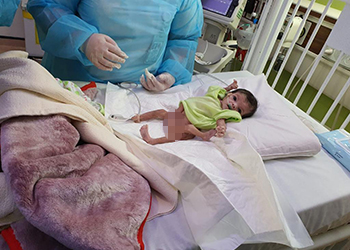 التوأم الطفيلي تتلقى الرعاية الطبية بمستشفى الملك عبدالله التخصصي للأطفال